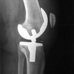 artificial knee joint